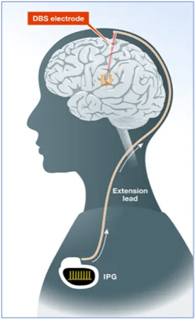 DBS Implant